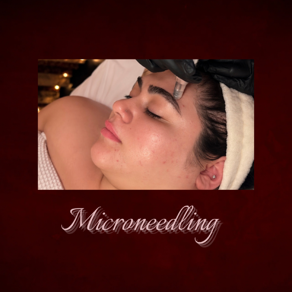 Microneedling at Aesthetics By Chelle in Mesa, AZ