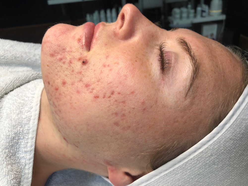 Acne Consultation And Treatments