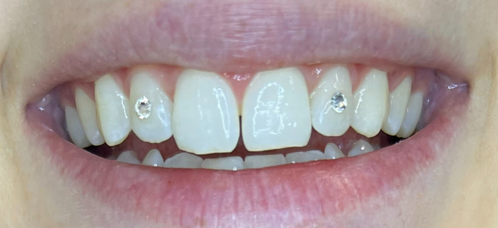 Tooth Gems (Small)