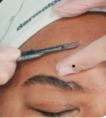Dermaplaning Treatment