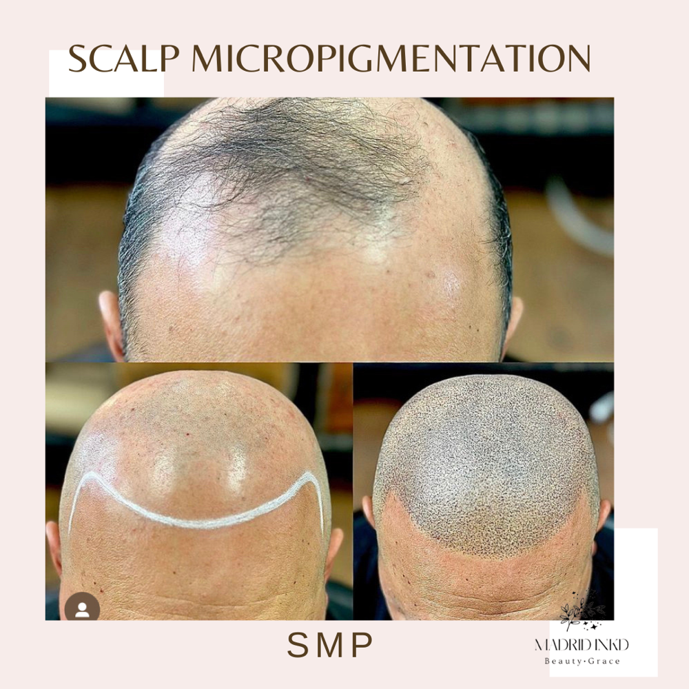 Scalp Micropigmentation Men