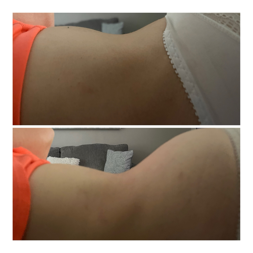 Fat Reduction Treatment July Sale