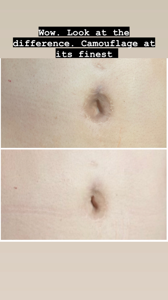 Camouflage Stretch Marks And Brows at Juanita’s Brows in Fresno, CA