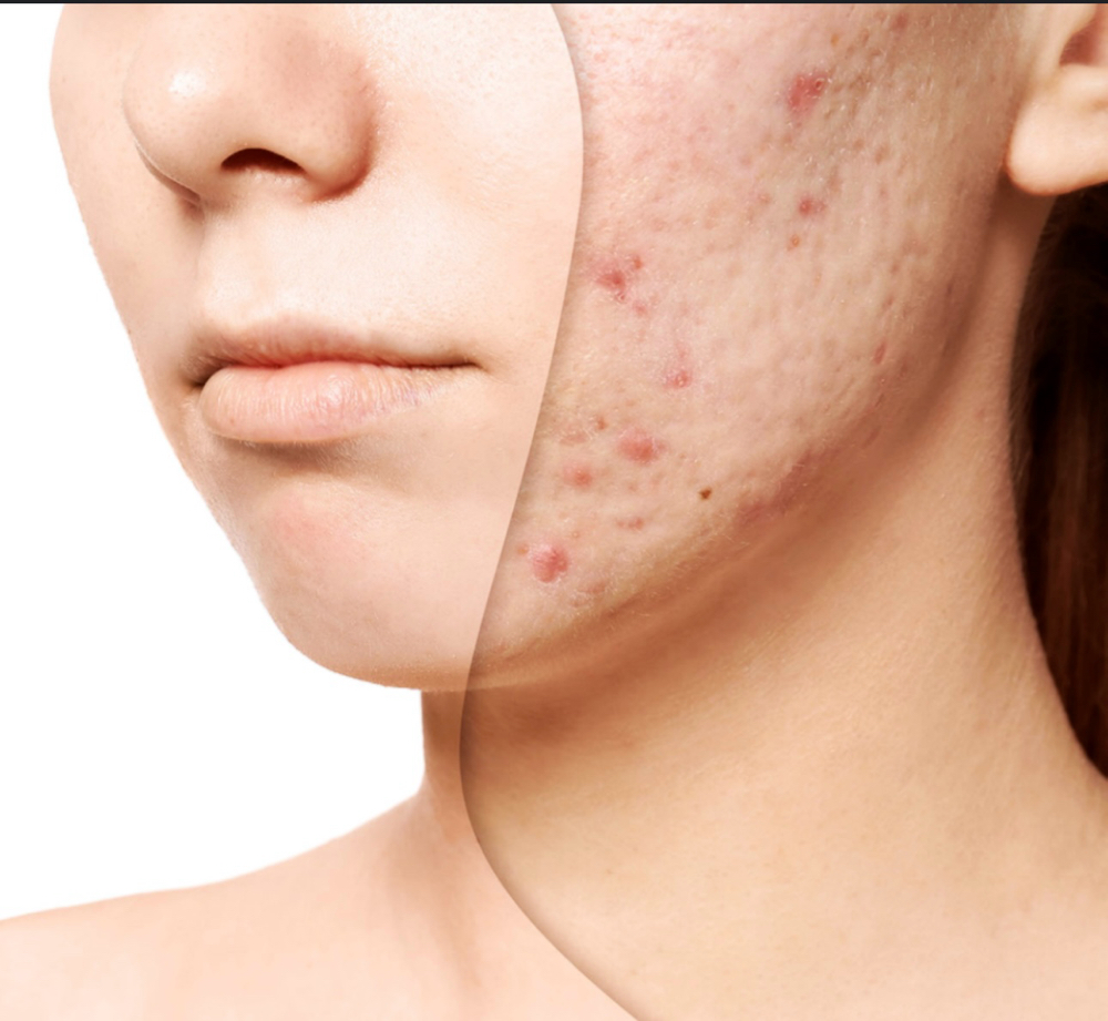 Acne Facial
