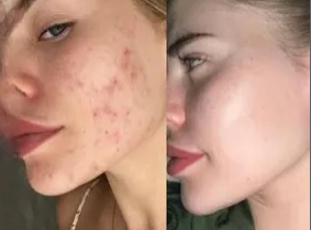 Acne Treatment Facial
