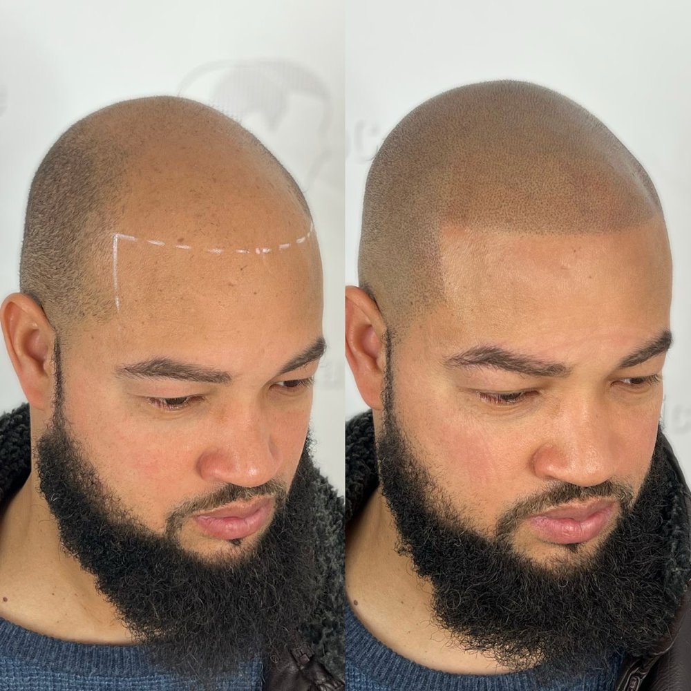 Micro Scalp Pigmentation