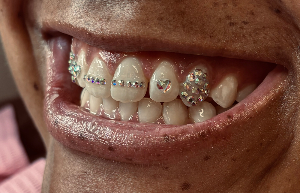 2 TEETH BRACE BAR