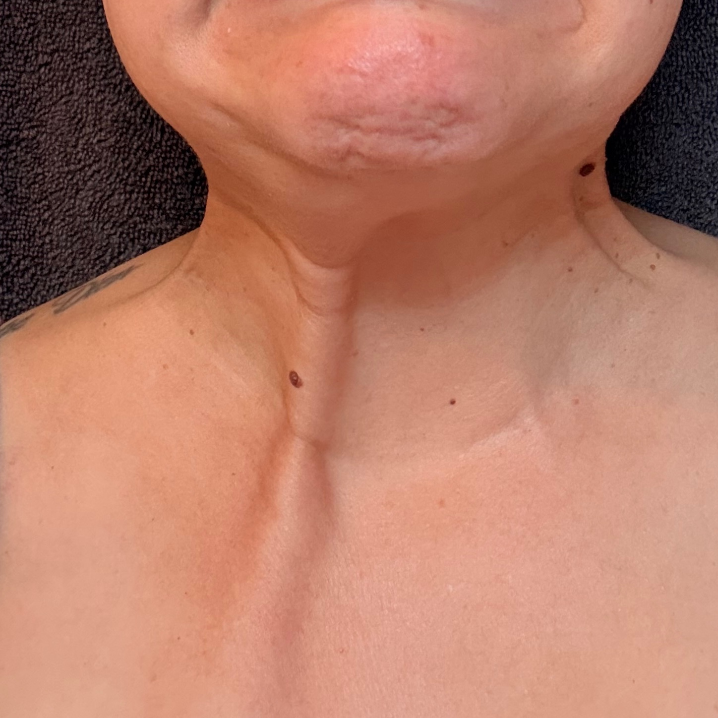 Platysmal Bands at Radiant Aesthetics by Liz in El Paso, TX