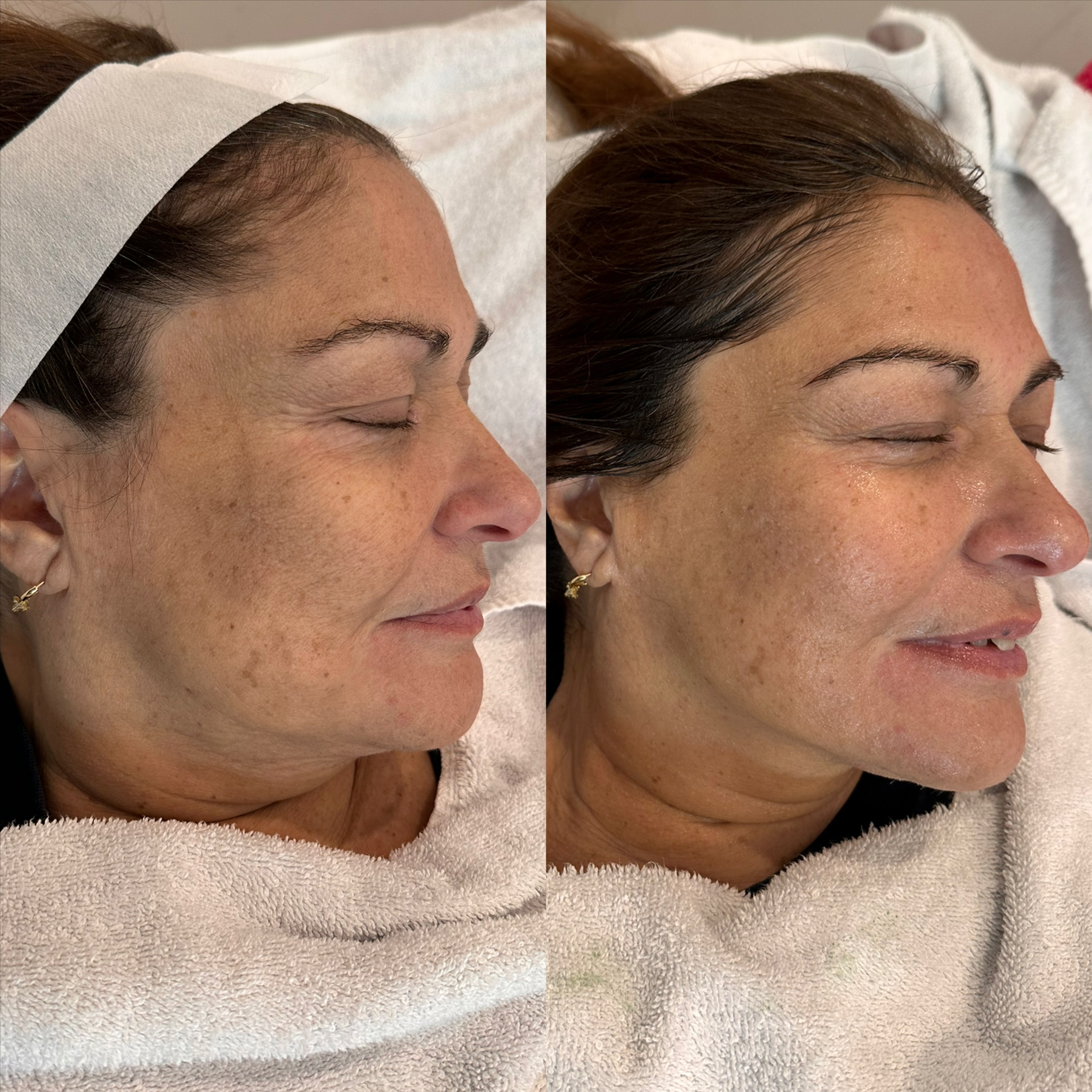 Stem Cell Microneedling at Jewels Beauty in Fairview, NJ
