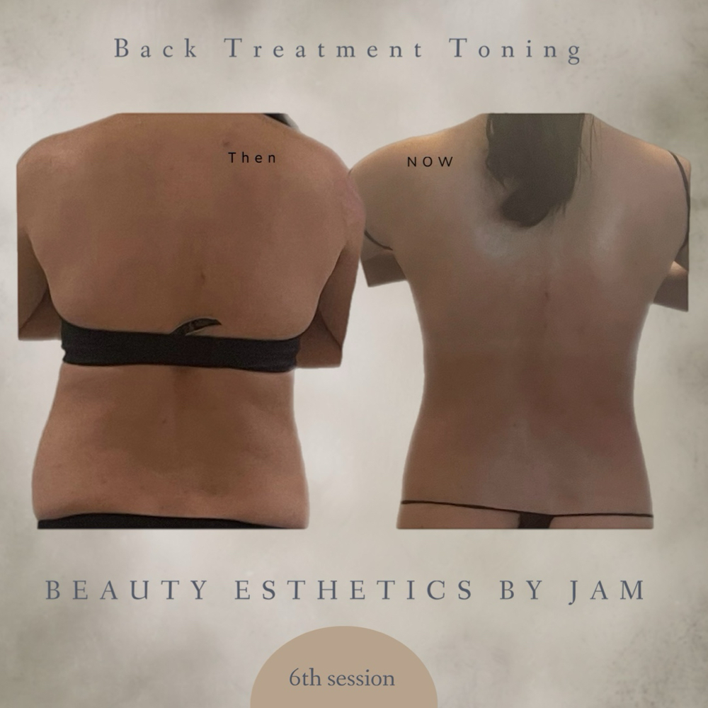 Back Treatment Toning