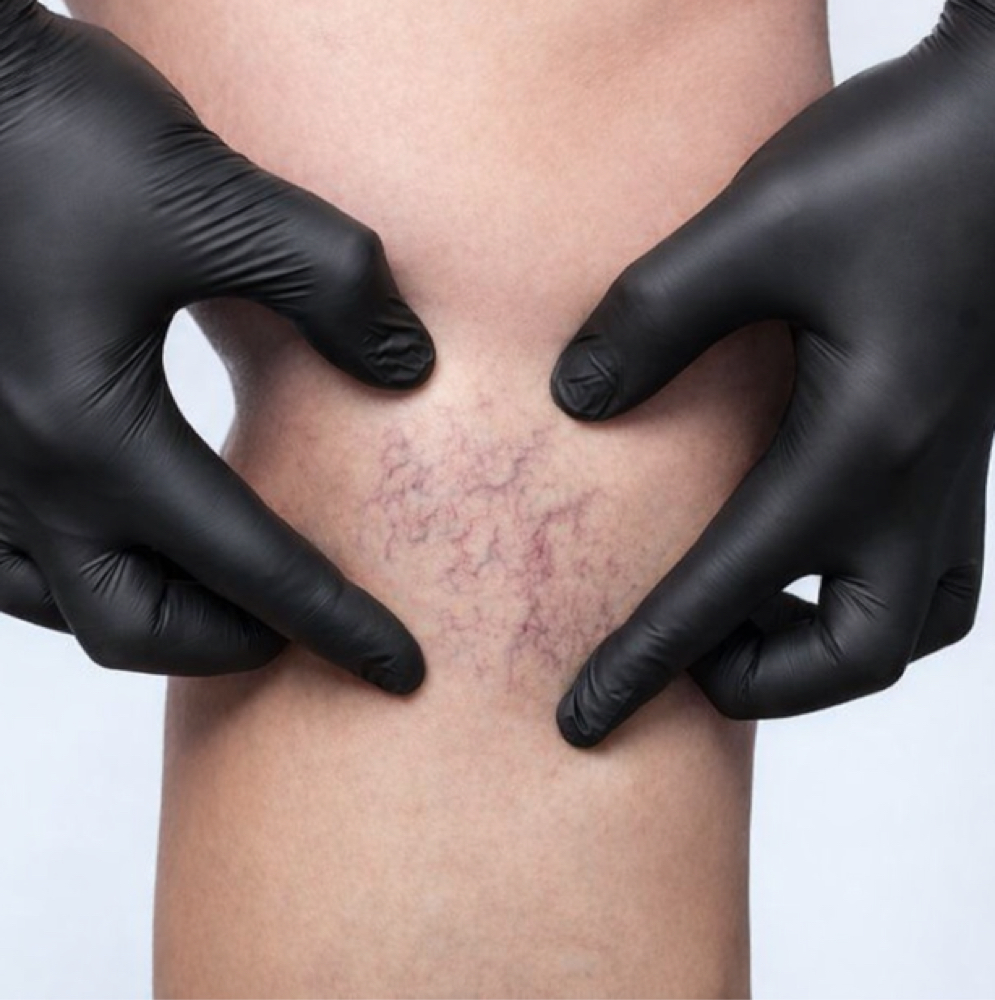 Sclerotherapy (Vein) 3 Treatments