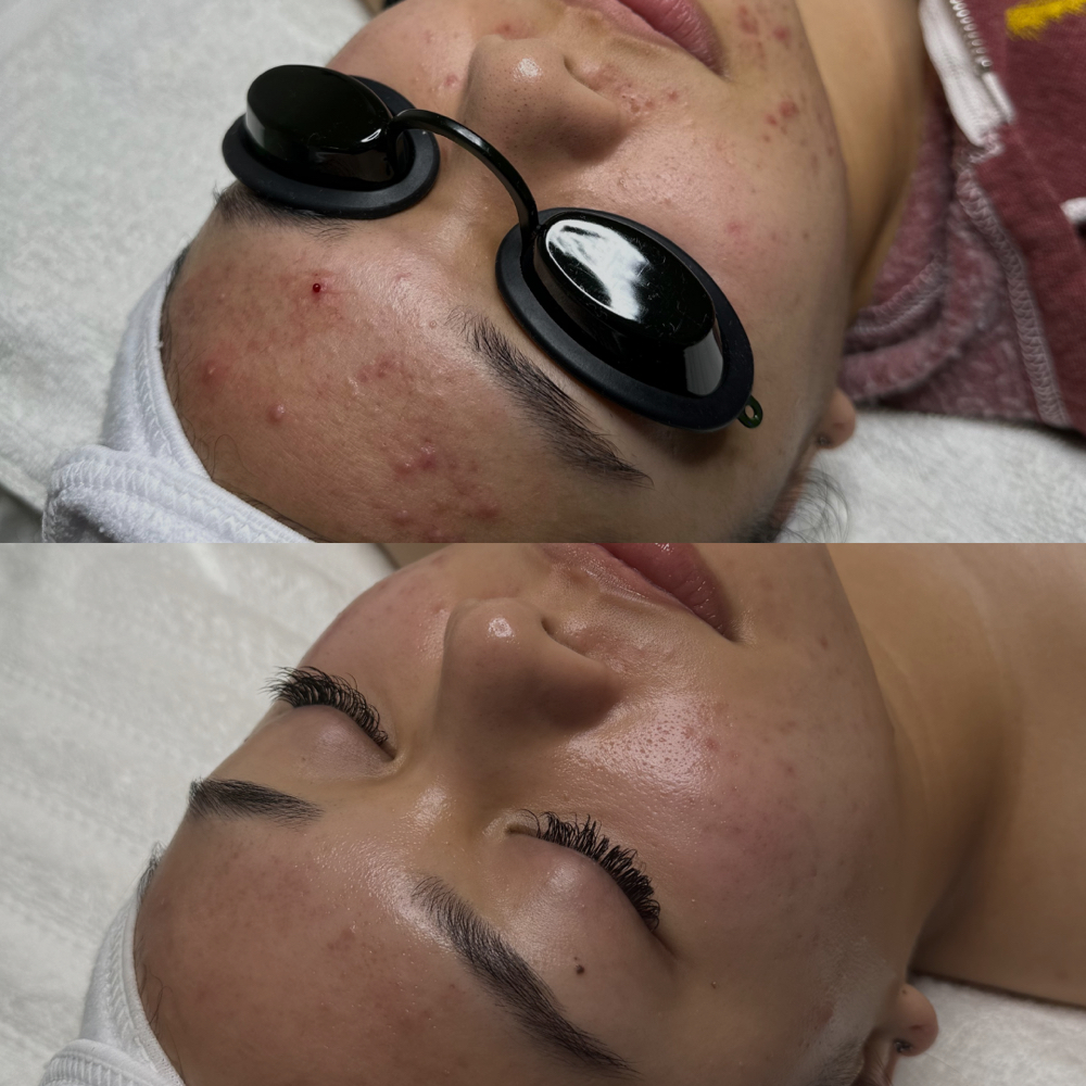 Clear Skin Program Consult + Facial at Floraison Beauty in Vacaville, CA