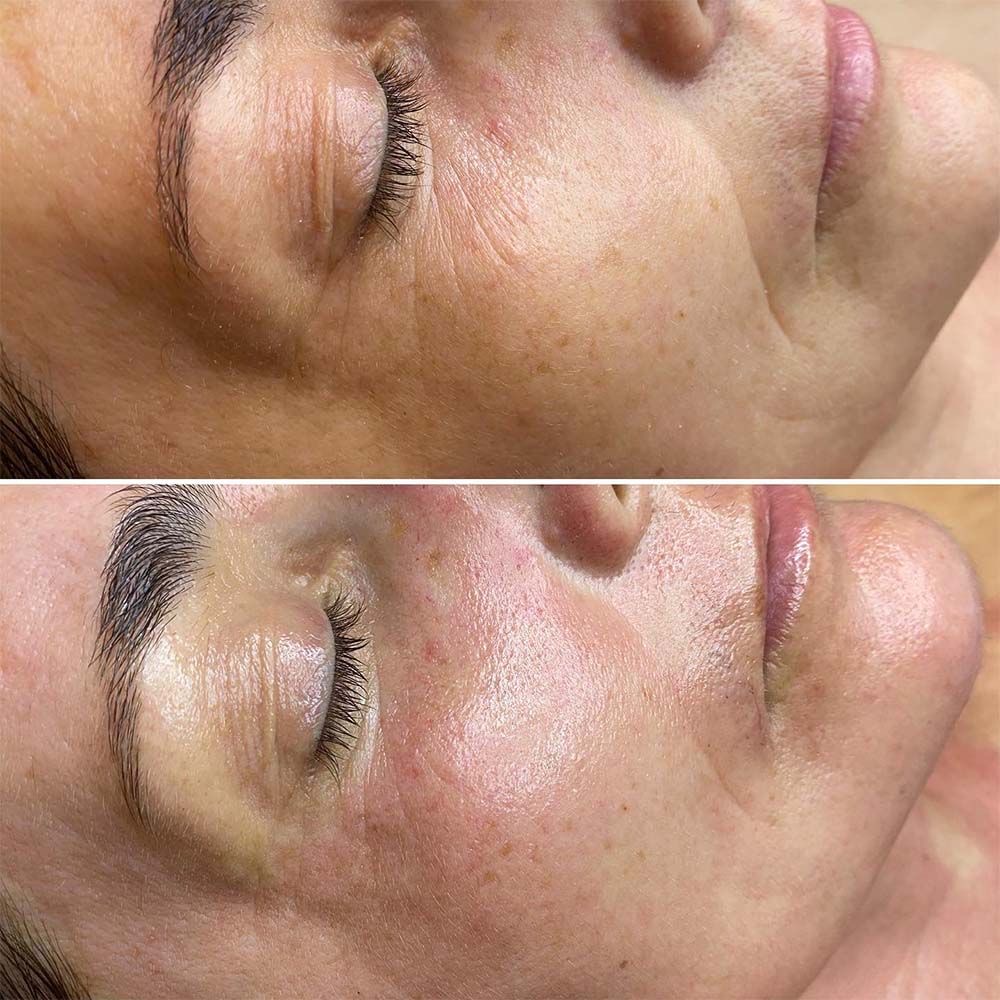 Anti Aging Lira Lux at Reborn beauty spa in Beverly, MA
