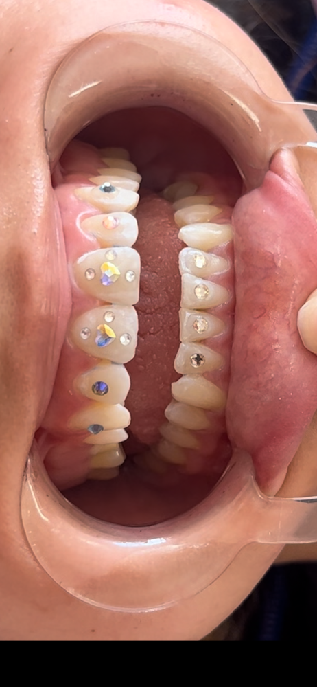 Tooth Gem Free Style