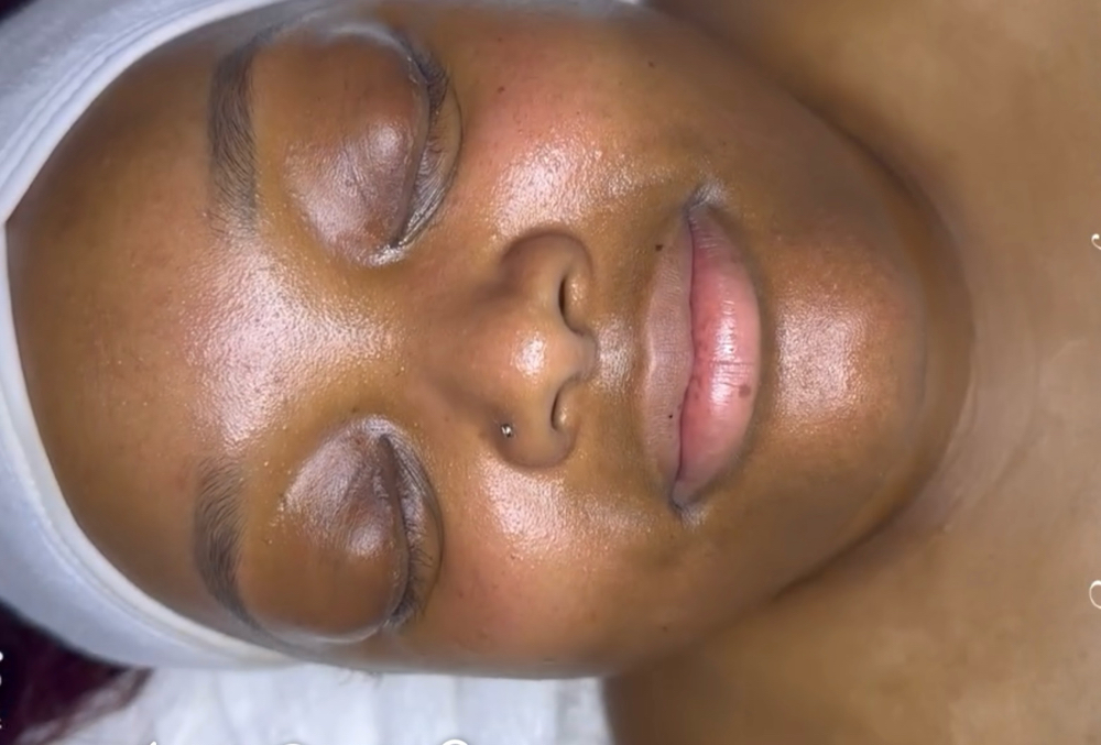Hyaluronic Acid Facial