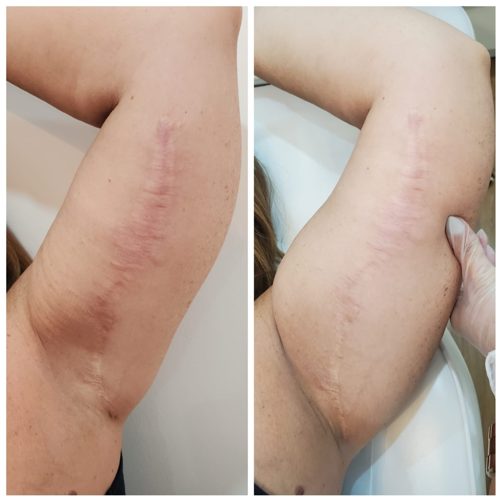 SCAR REVISION at PMU ink and beauty in Monterey, CA