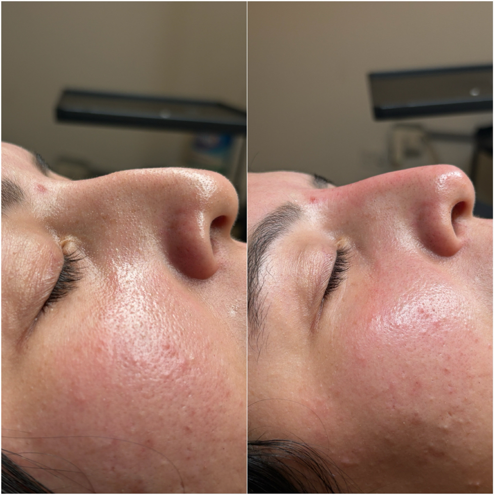 Rinomoderación /Acido hialuronico at Sashy Beauty Studio in Carolina, PR