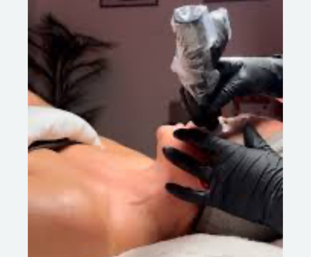 Neck Add On Microchanneling