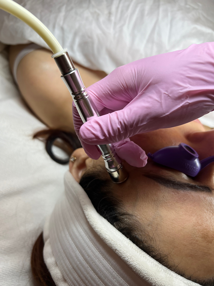 Microdermabrasion