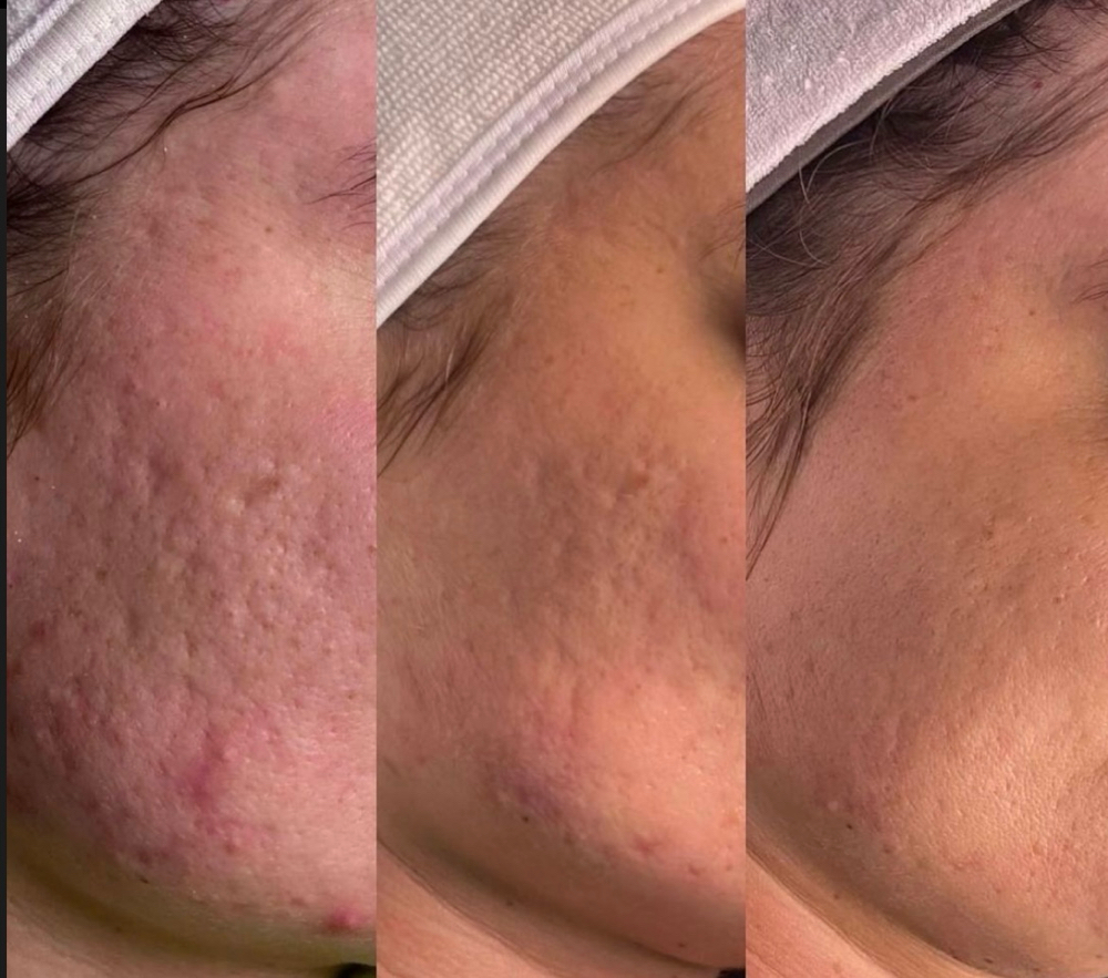 Acne Scar Program