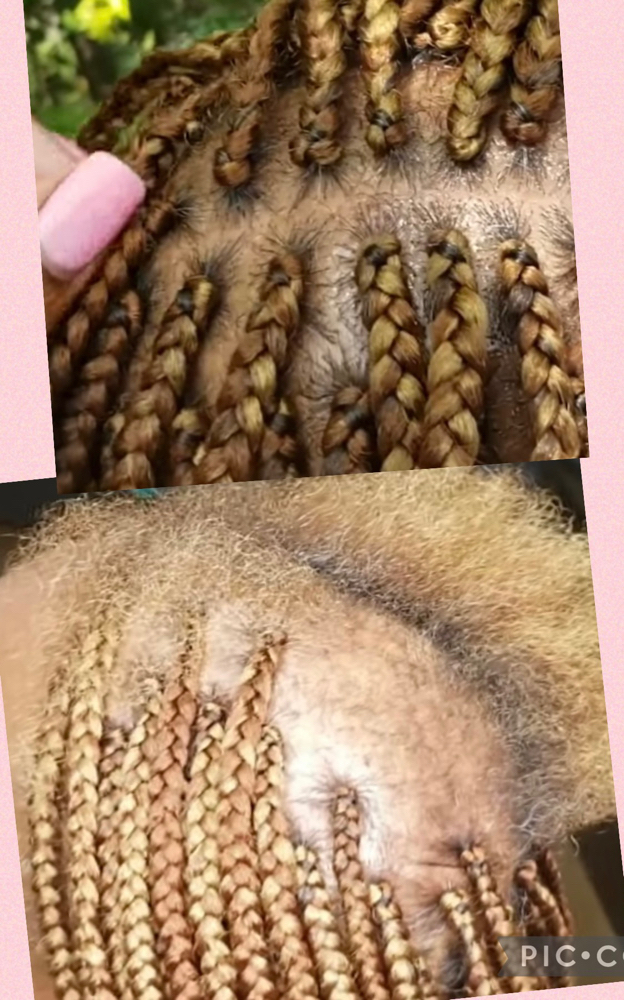 Alopecia/Hair Loss Box Braids