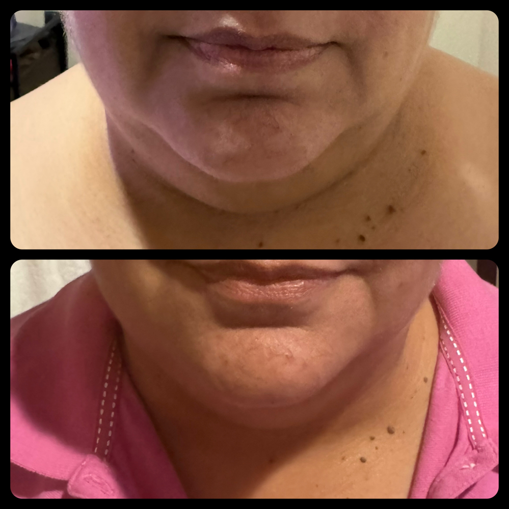 Double Chin Treatment