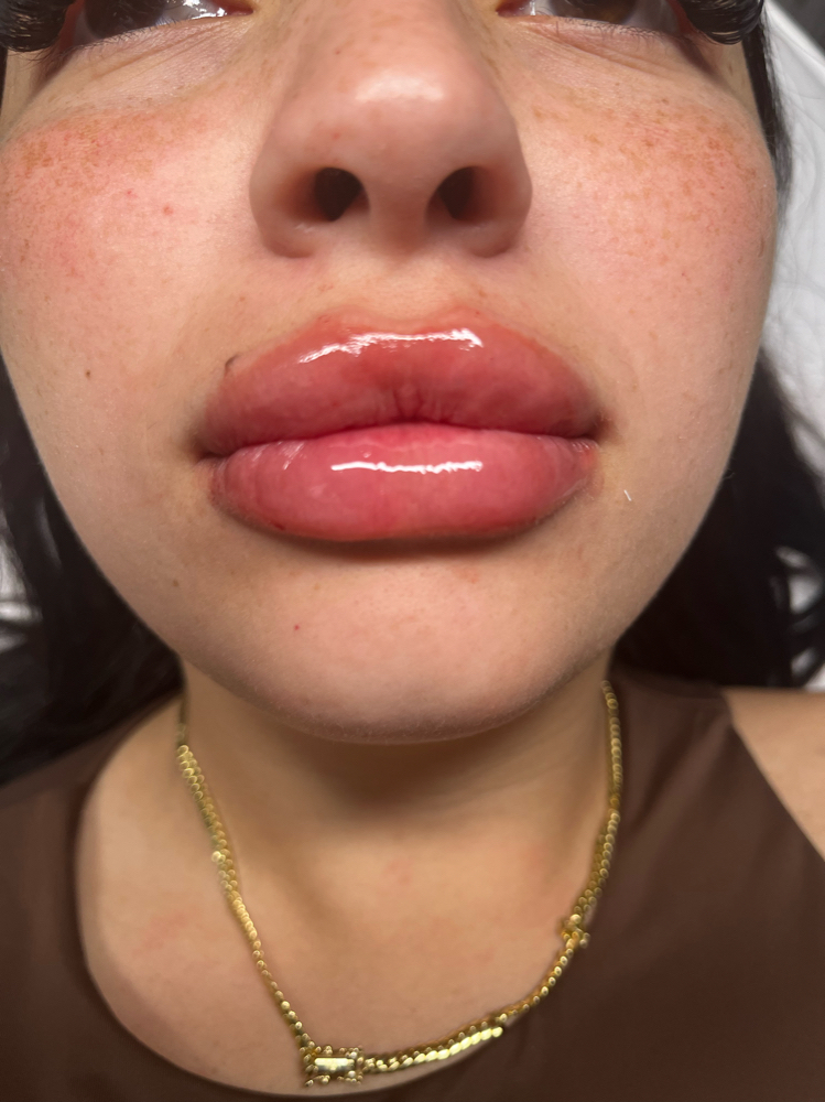 Lip hydation & volumen