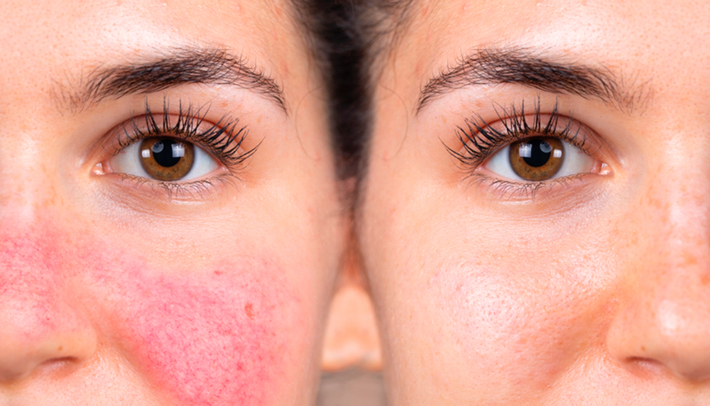 Sensitive Skin / Rosacea Treatment