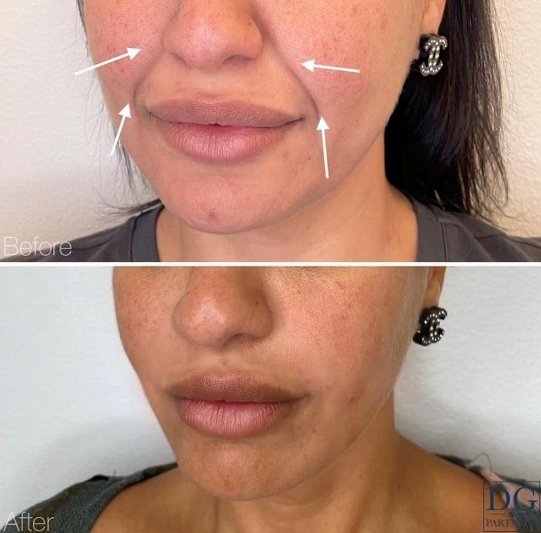 Smile Lines/ Nasolabial Folds