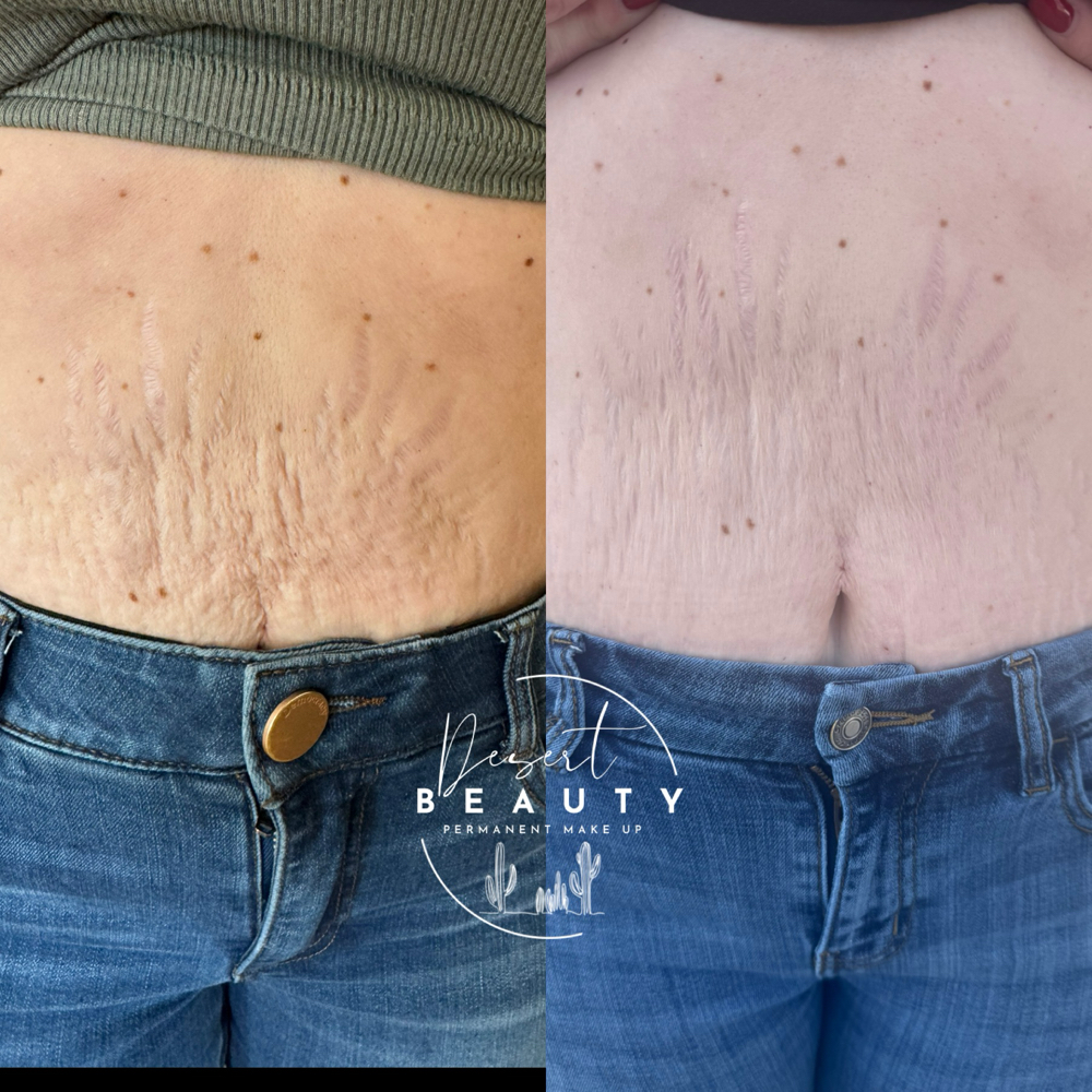 Inkless Stretch Mark Revision (ISR)