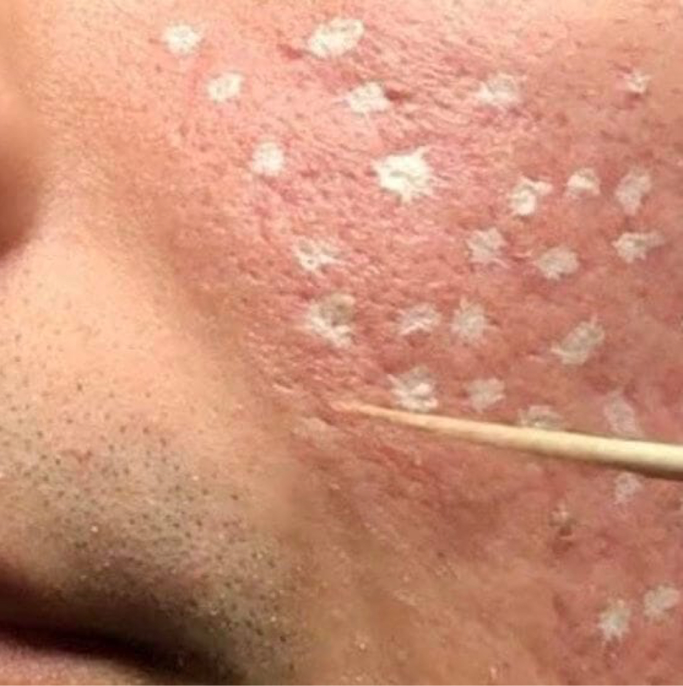 TCA cross | acne scar revision at Corrective treatments + professional skincare in Atlanta, GA