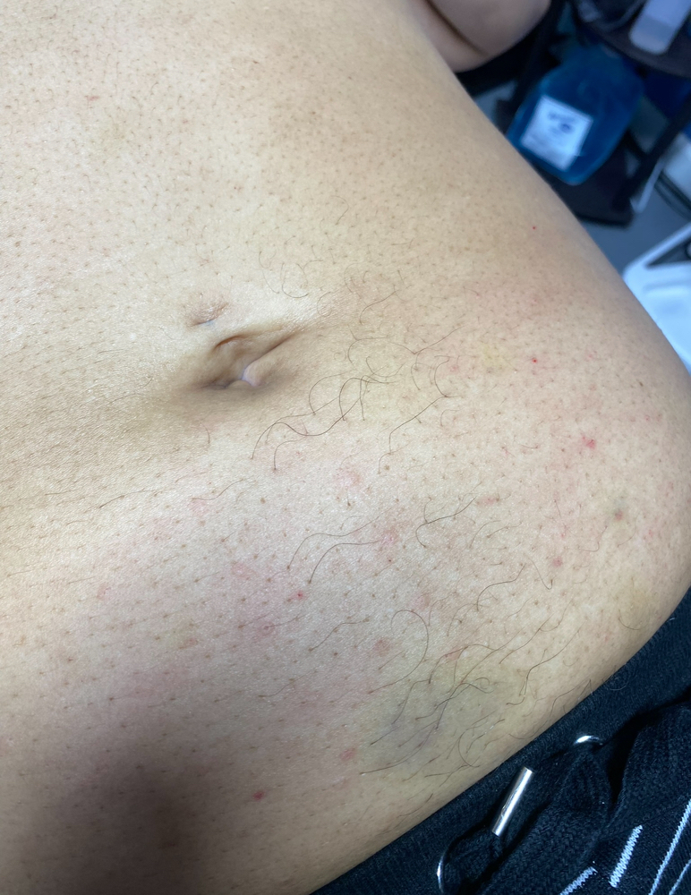 Fat Dissolve Lower Abdomen
