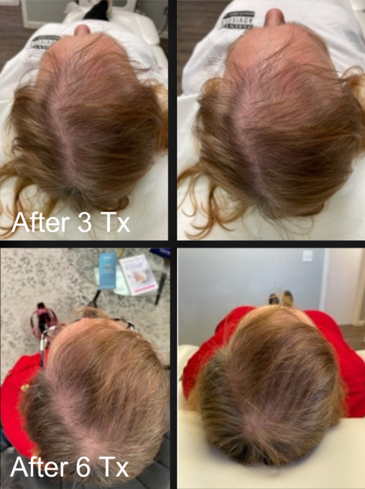 Ultra - Hair Restoration