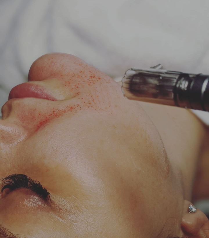 Microneedling with hyaluronic acid