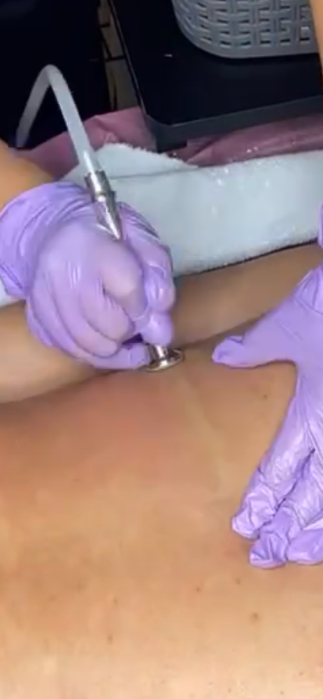 Microdermabrasion Add On