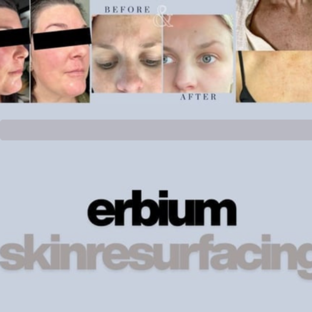 Erbium Surfacing Package at The Skin Bar & Med Spa in Bryant, AR