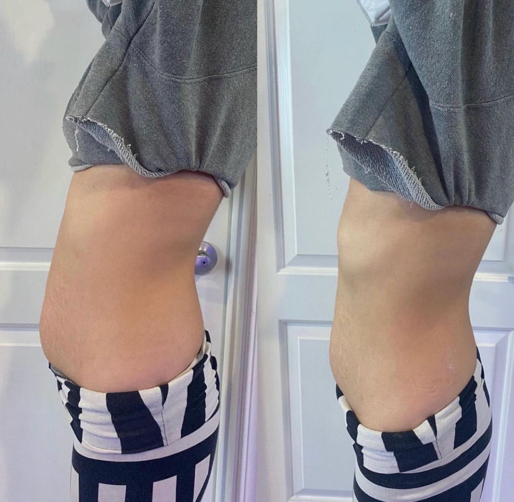 Sculpt & Tighten RF Body Treatment at Glowup Beauty LA LLC in Highland Park, CA