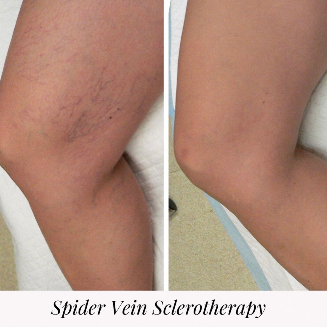 Sclerotherapy at Injection Fix & Wellness LLC in Amarillo, TX