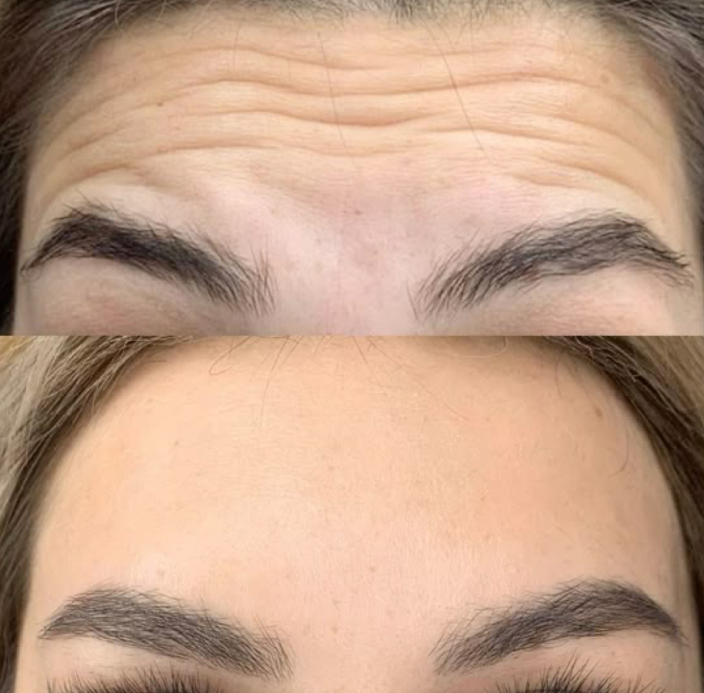 Botox / daxxify