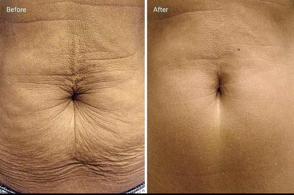 Skin Tighting