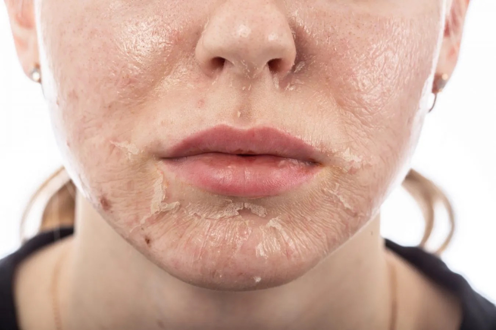 Bye, Bye Blemish Chemical Peel