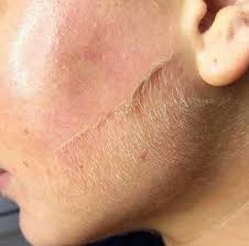 Dermaplaning Treatment