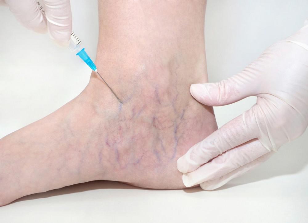 Asclera Spider Vein Removal