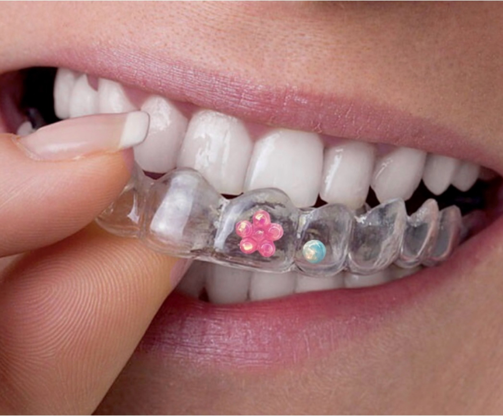 Clear Retainer w/Tooth Gems