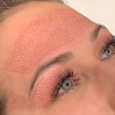 Plasma Fibroblast- Forehead