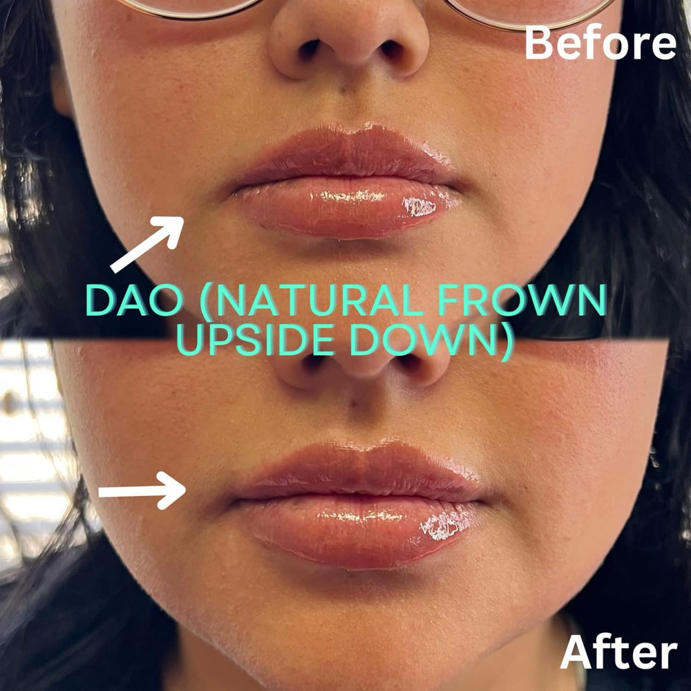 Tox-DOA’s (RBF)💉 at BeautyHolic Aesthetics LLC in Lubbock, TX