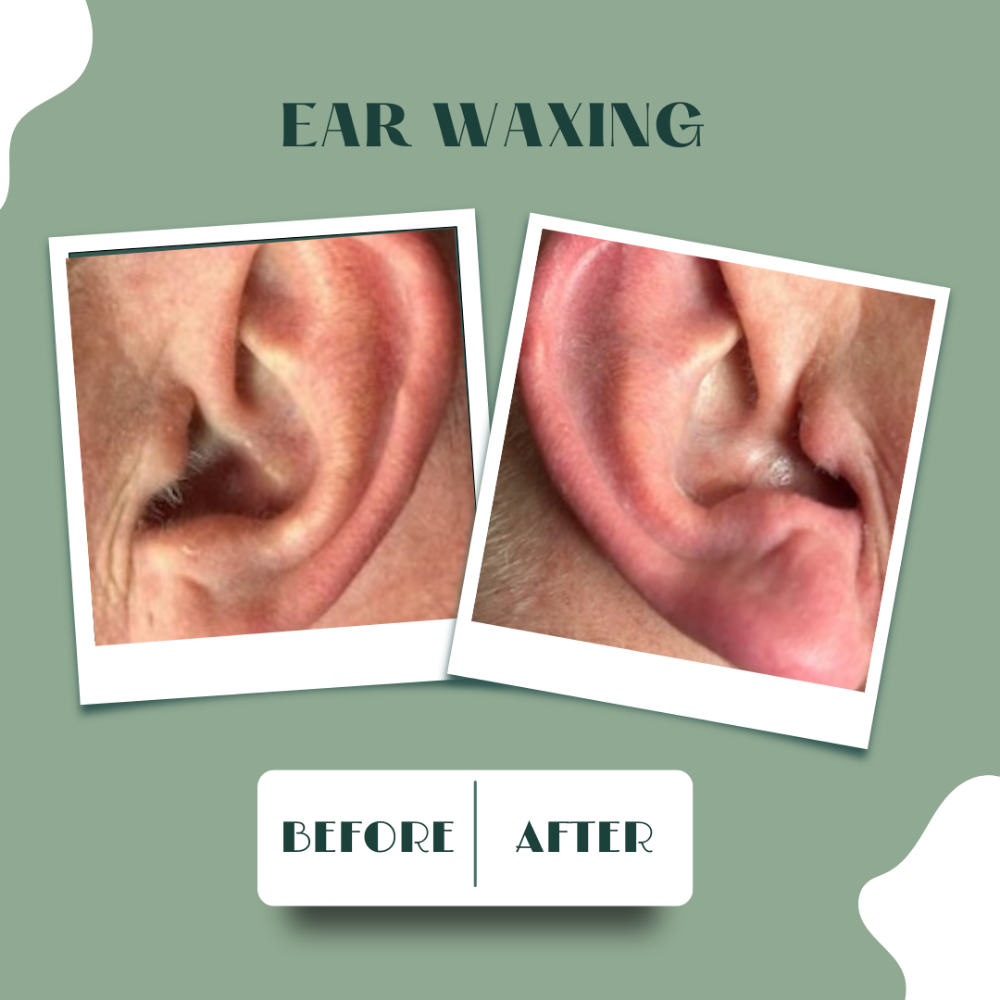 Ear/Lobe Wax