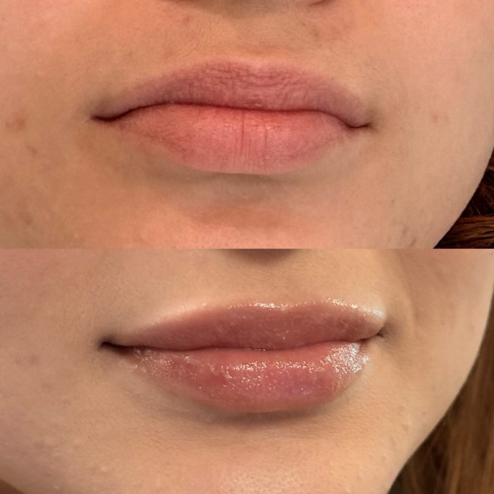 The Little Plump at TRES Aesthetics in Missouri, TX