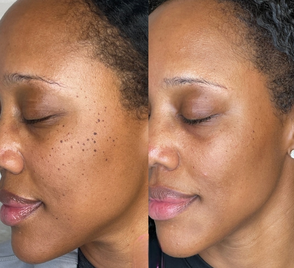 DPN & Skin Tag Removal