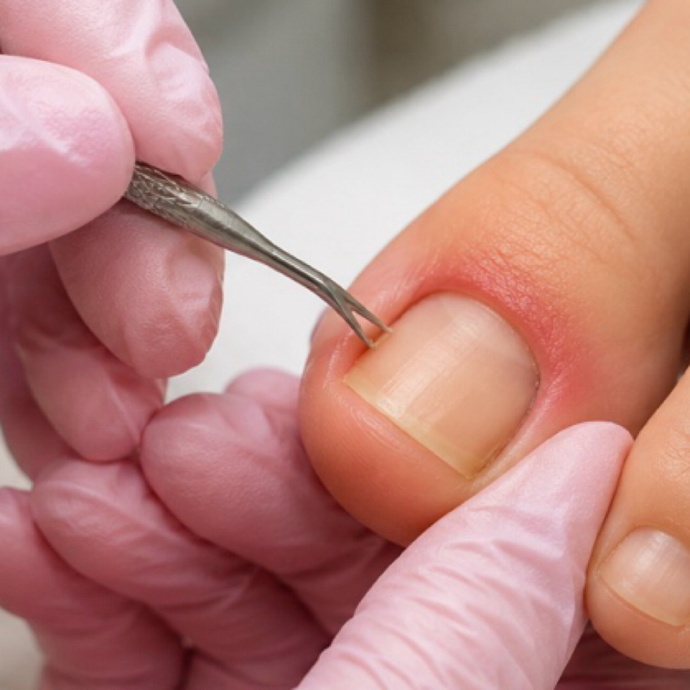 Ingrown Toenail Relief at Cataleya's Nail Salon and Boutique in Phoenix, AZ